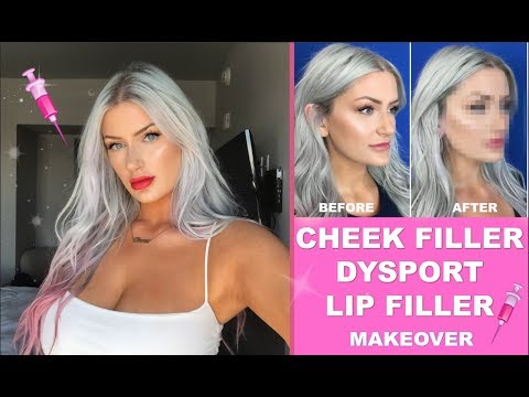 ✨ THE RESULTS ARE INSANE 😱 I GET CHEEK FILLER & DYSPORT for the first time 💓