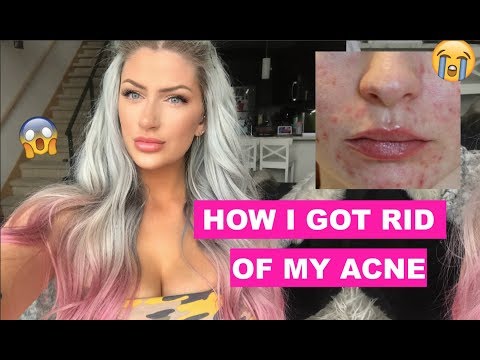 👏🏻 HOW I GOT RID OF MY ACNE 👋🏻 BroadBand Light laser